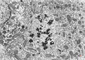 M,16y. | lipofuscin - hyperbilirubinaemia - Gilbert or Dubin-Johnson syndrome M,16y. | lipofuscin - hyperbilirubinaemia - Gilbert or Dubin-Johnson syndrome